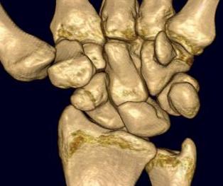 Scaphoid Tuberosity Fracture